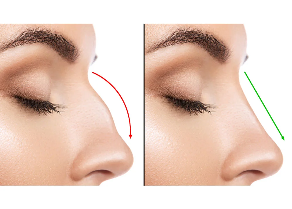 ρινοπλαστική πριν και μετά