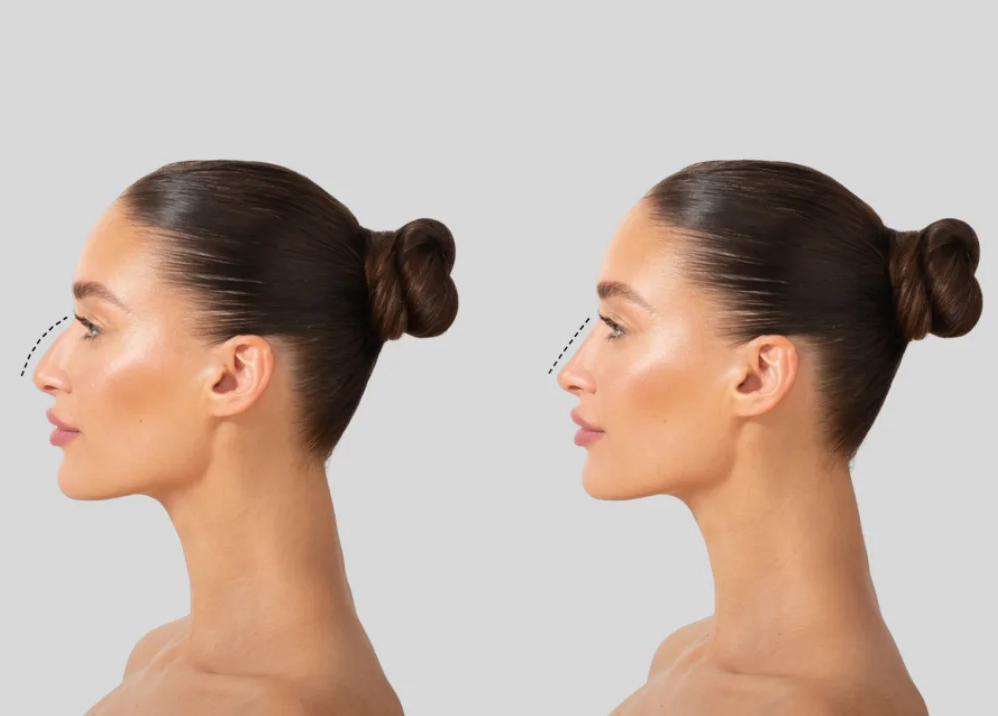 Ποια τεχνική είναι καλύτερη για να αποκτήσεις μια όμορφη μύτη;