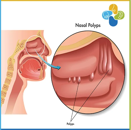 Πολύποδες Ρινός