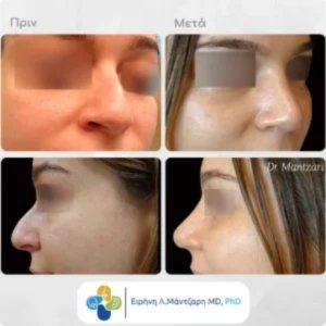 Ρινοπλαστικη